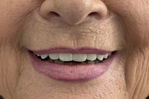 DOPO